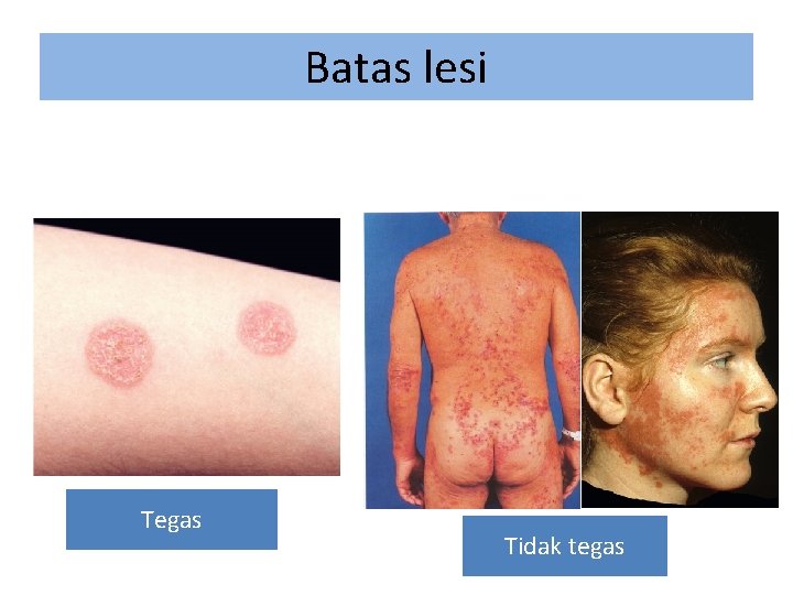 Batas lesi Tegas Tidak tegas 