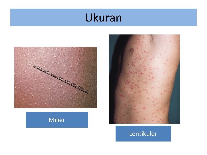 Ukuran Milier Lentikuler 