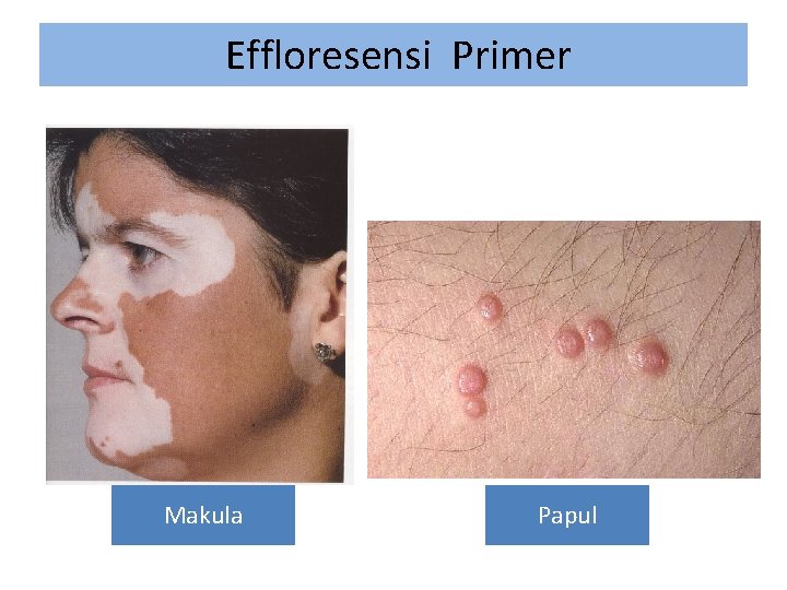 Effloresensi Primer Makula Papul 
