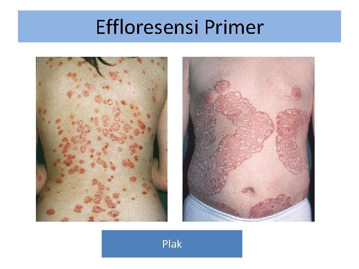 Effloresensi Primer Plak 