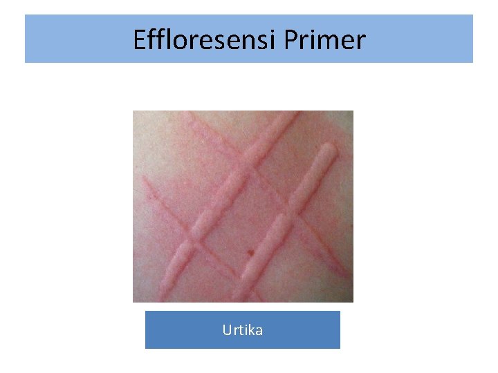 Effloresensi Primer Urtika 