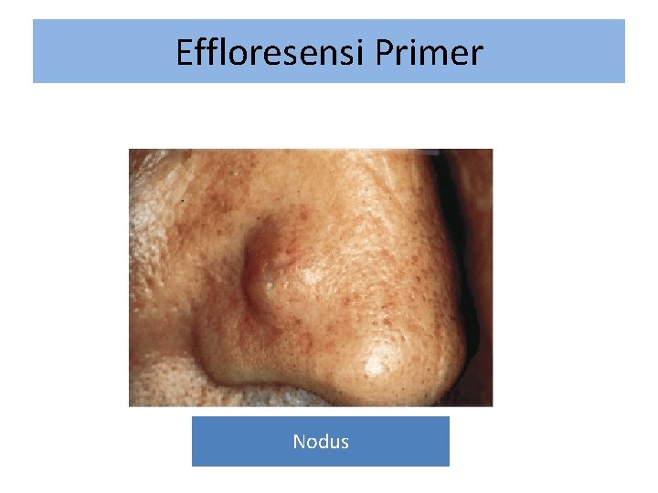 Effloresensi Primer Nodus 