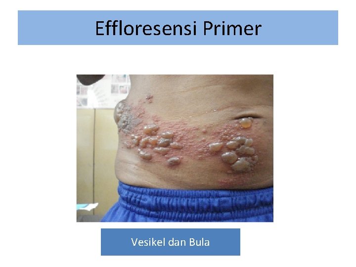 Effloresensi Primer Vesikel dan Bula 