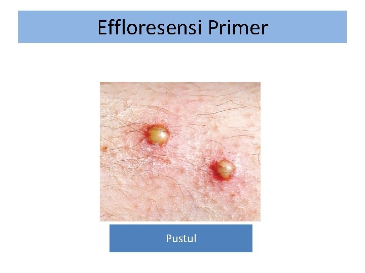 Effloresensi Primer Pustul 