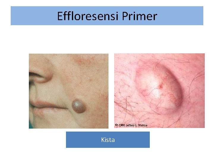 Effloresensi Primer Kista 
