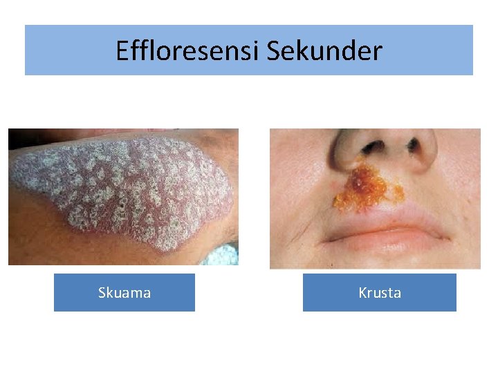 Effloresensi Sekunder Skuama Krusta 