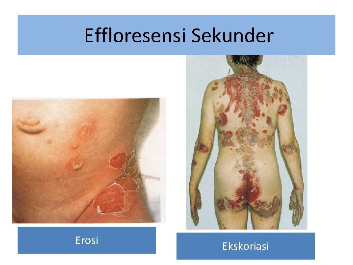 Effloresensi Sekunder Erosi Ekskoriasi 