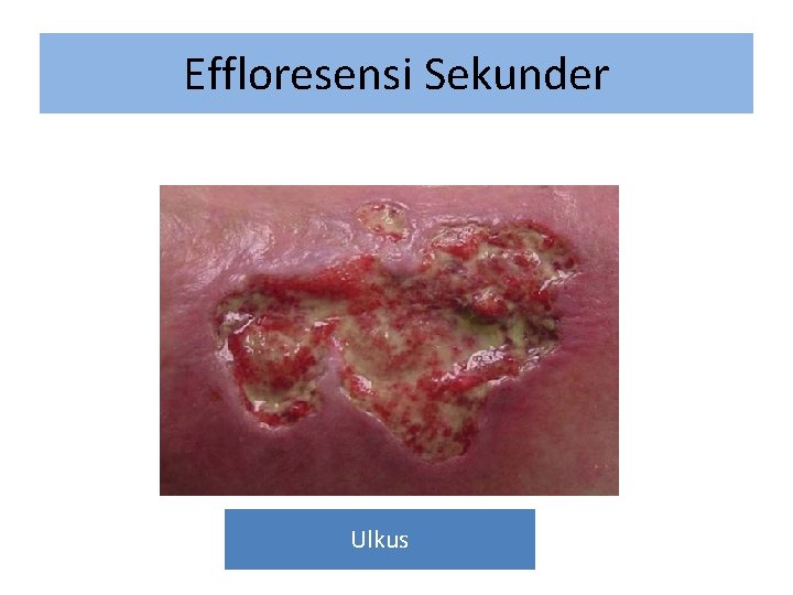 Effloresensi Sekunder Ulkus 