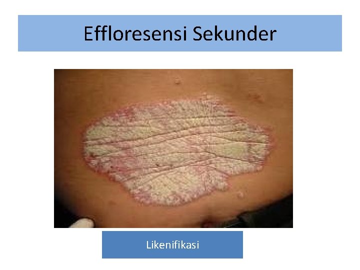 Effloresensi Sekunder Likenifikasi 