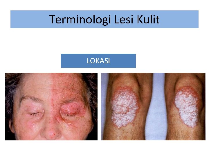 Terminologi Lesi Kulit LOKASI 