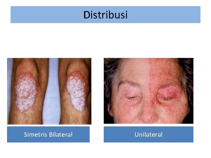 Distribusi Simetris Bilateral Unilateral 