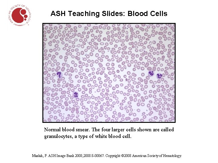 ASH Teaching Slides: Blood Cells Normal blood smear. The four larger cells shown are