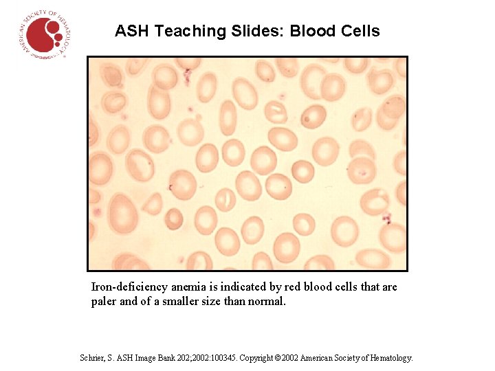 ASH Teaching Slides: Blood Cells Iron-deficiency anemia is indicated by red blood cells that