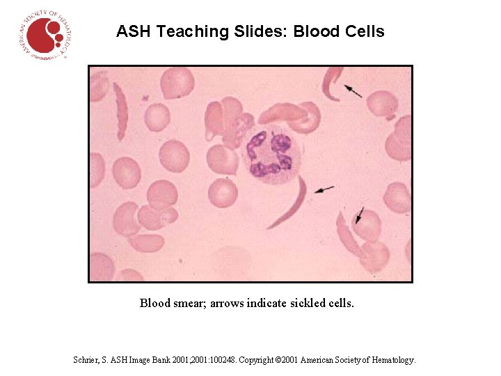 ASH Teaching Slides: Blood Cells Blood smear; arrows indicate sickled cells. Schrier, S. ASH