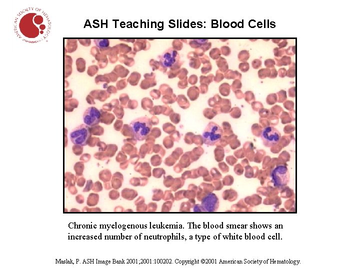 ASH Teaching Slides: Blood Cells Chronic myelogenous leukemia. The blood smear shows an increased