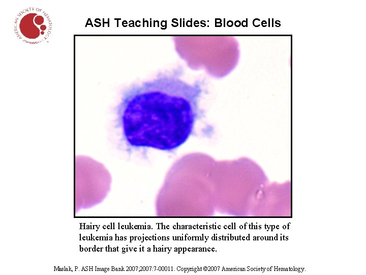 ASH Teaching Slides: Blood Cells Hairy cell leukemia. The characteristic cell of this type