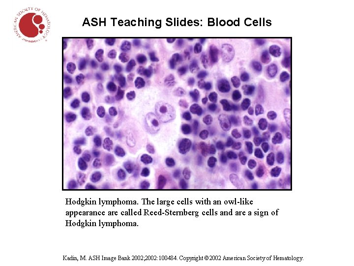 ASH Teaching Slides: Blood Cells Hodgkin lymphoma. The large cells with an owl-like appearance
