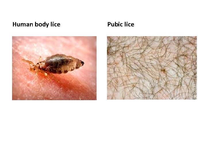 Human body lice Pubic lice 