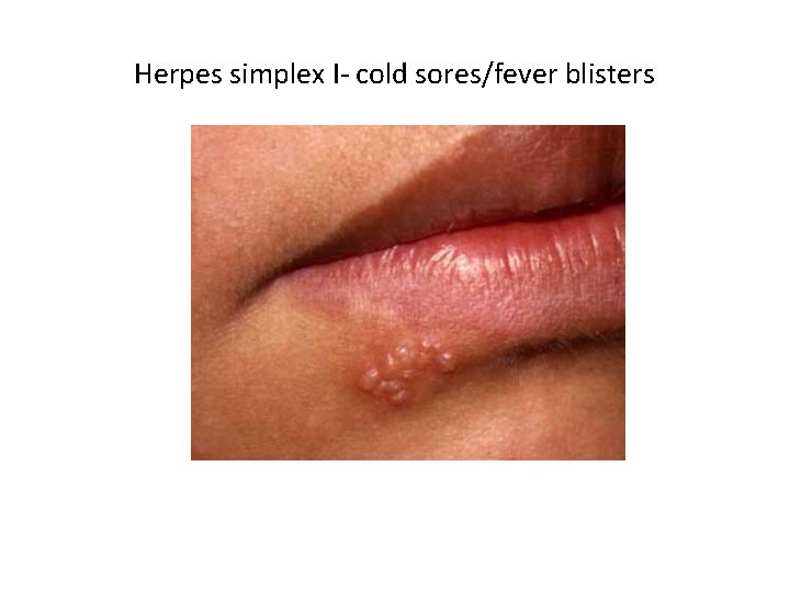 Herpes simplex I- cold sores/fever blisters 