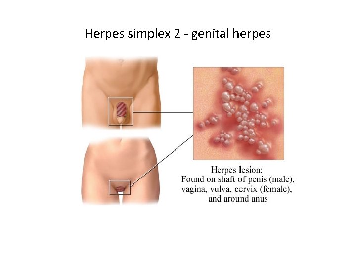 Herpes simplex 2 - genital herpes 