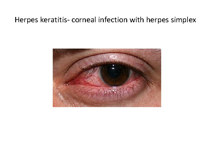 Herpes keratitis- corneal infection with herpes simplex 