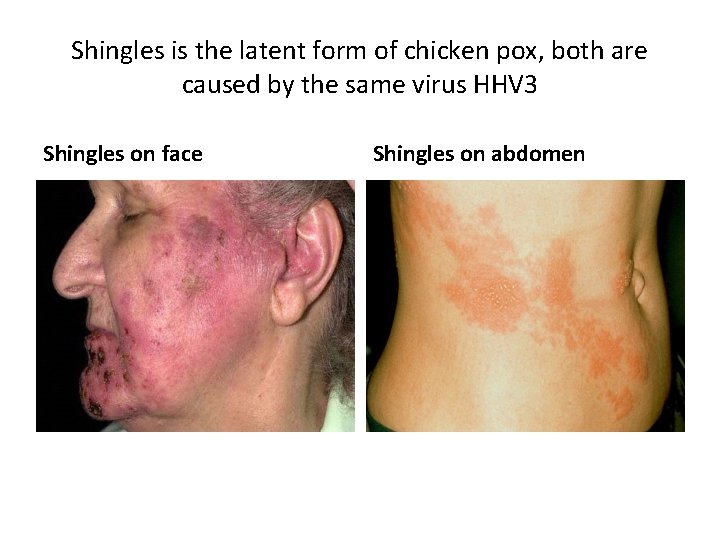 Shingles is the latent form of chicken pox, both are caused by the same