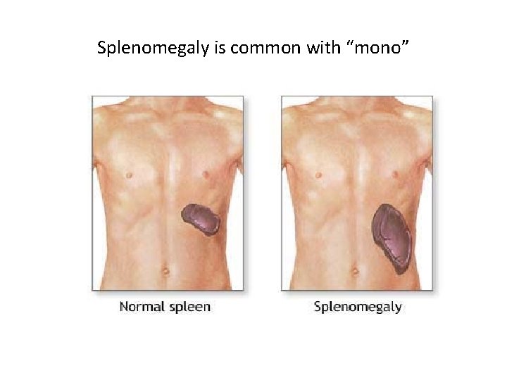 Splenomegaly is common with “mono” 
