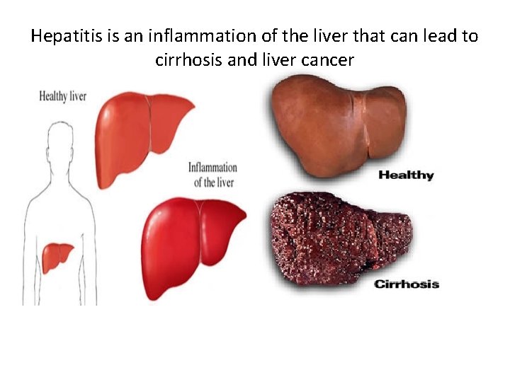 Hepatitis is an inflammation of the liver that can lead to cirrhosis and liver