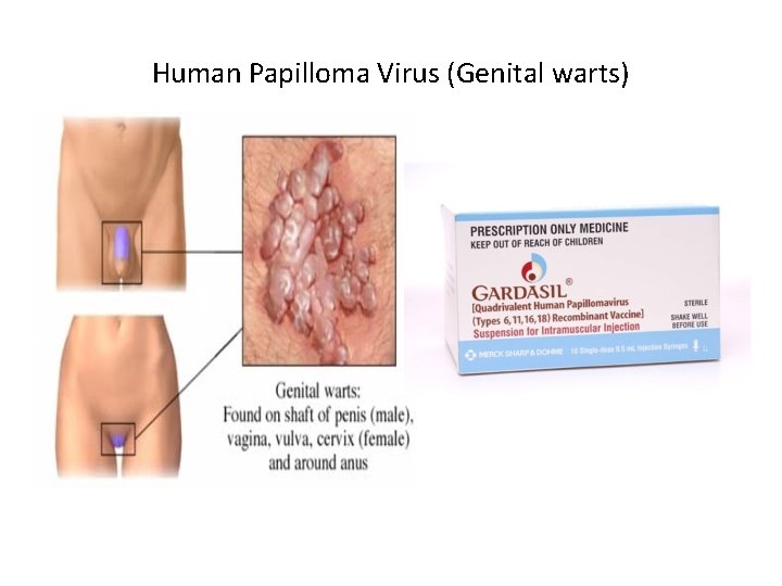 Human Papilloma Virus (Genital warts) 