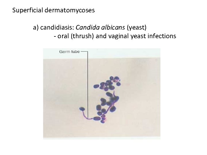 Superficial dermatomycoses a) candidiasis: Candida albicans (yeast) - oral (thrush) and vaginal yeast infections