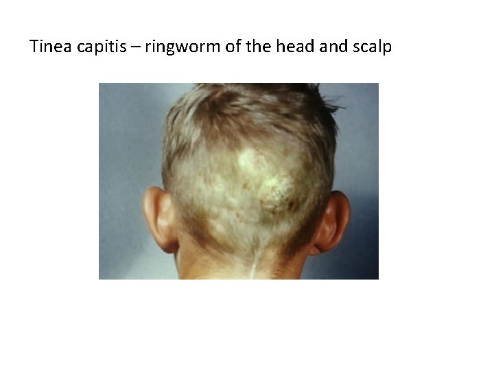 Tinea capitis – ringworm of the head and scalp 