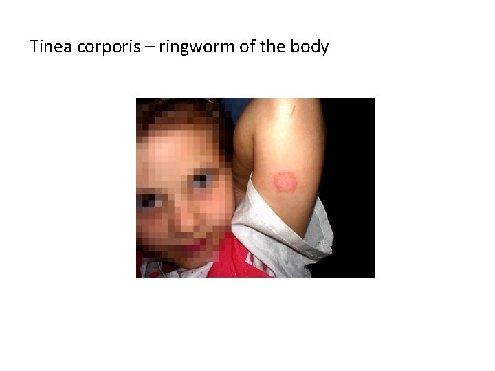 Tinea corporis – ringworm of the body 