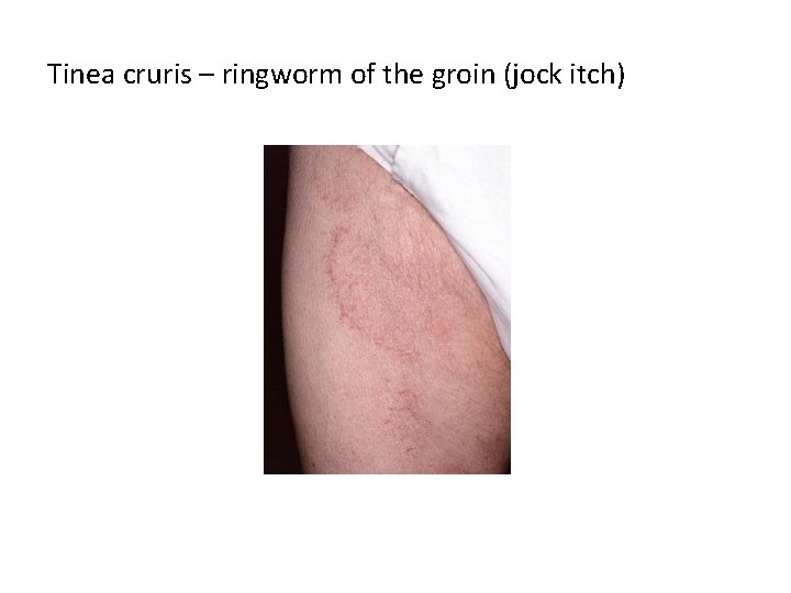 Tinea cruris – ringworm of the groin (jock itch) 