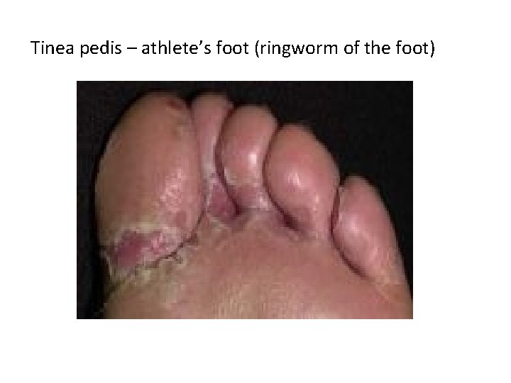 Tinea pedis – athlete’s foot (ringworm of the foot) 