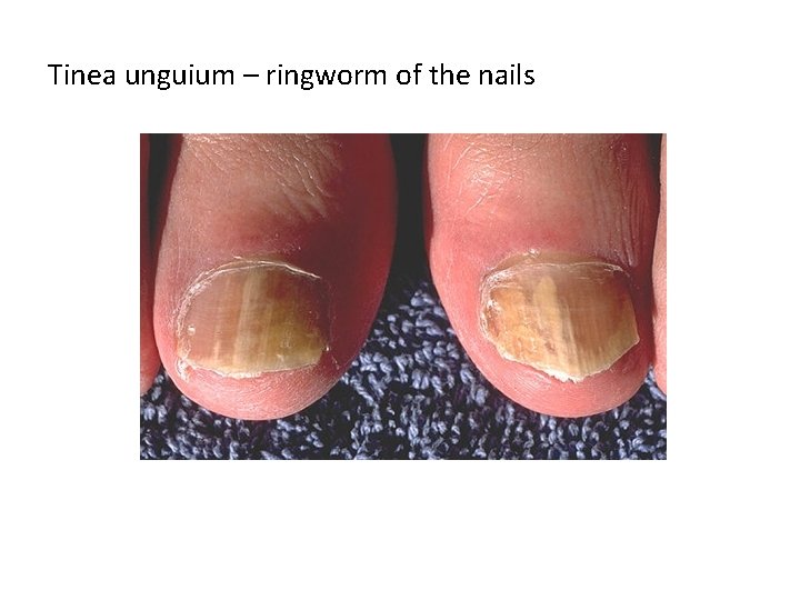 Tinea unguium – ringworm of the nails 