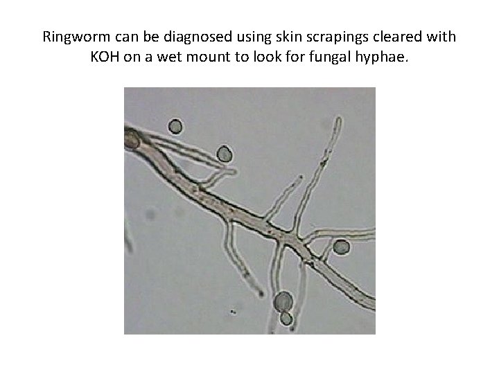 Ringworm can be diagnosed using skin scrapings cleared with KOH on a wet mount