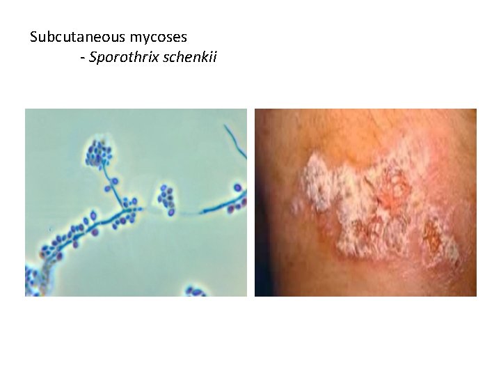 Subcutaneous mycoses - Sporothrix schenkii 