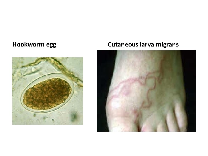 Hookworm egg Cutaneous larva migrans 
