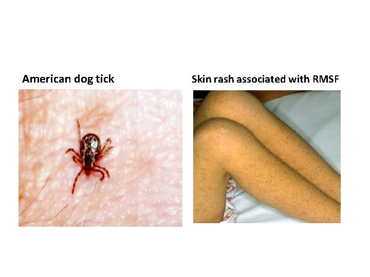 American dog tick Skin rash associated with RMSF 
