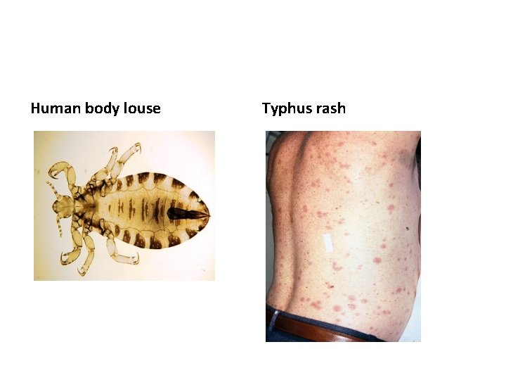 Human body louse Typhus rash 