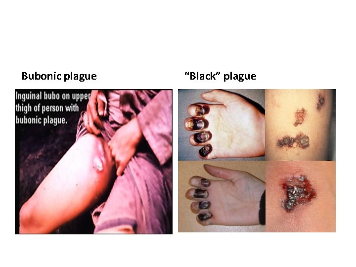 Bubonic plague “Black” plague 