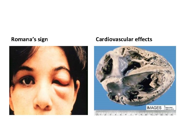 Romana’s sign Cardiovascular effects 