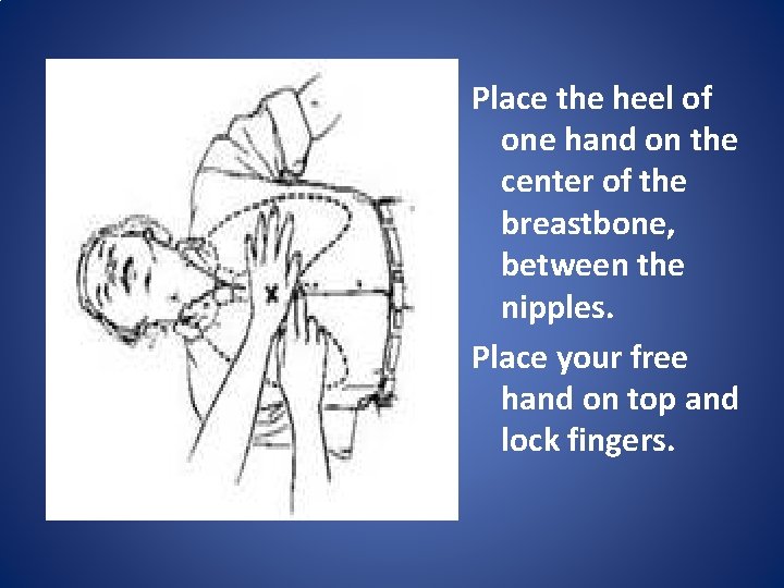 Place the heel of one hand on the center of the breastbone, between the