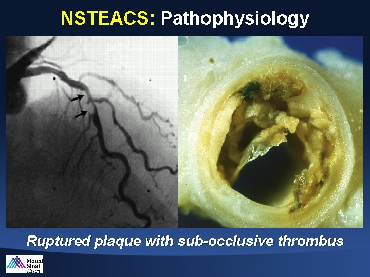 NSTEACS: Pathophysiology Ruptured plaque with sub-occlusive thrombus 