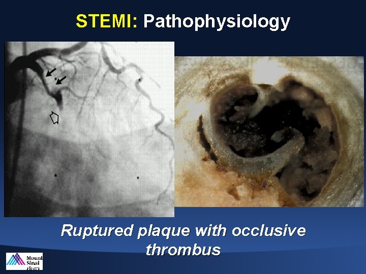 STEMI: Pathophysiology Ruptured plaque with occlusive thrombus 