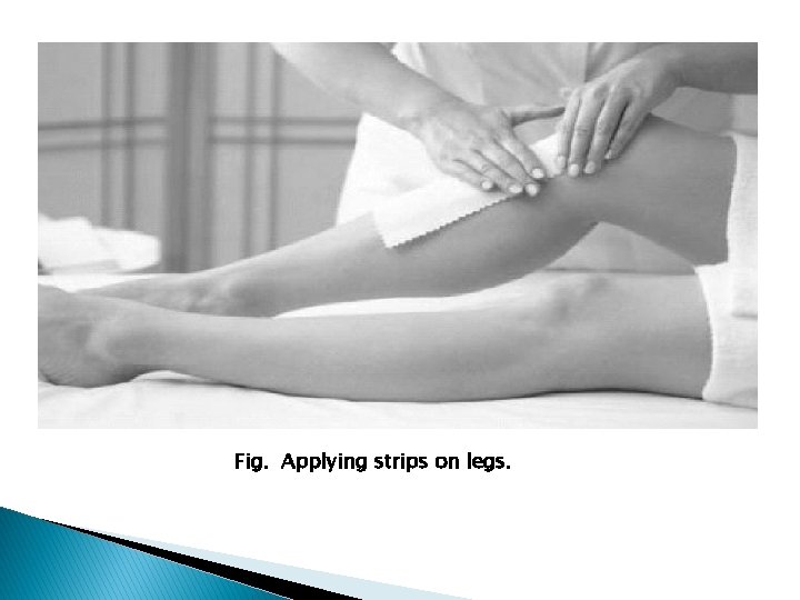 Fig. Applying strips on legs. 