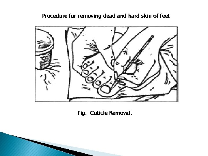 Procedure for removing dead and hard skin of feet Fig. Cuticle Removal. 