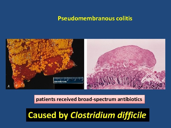 Pseudomembranous colitis patients received broad-spectrum antibiotics Caused by Clostridium difficile 