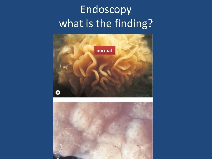 Endoscopy what is the finding? normal 