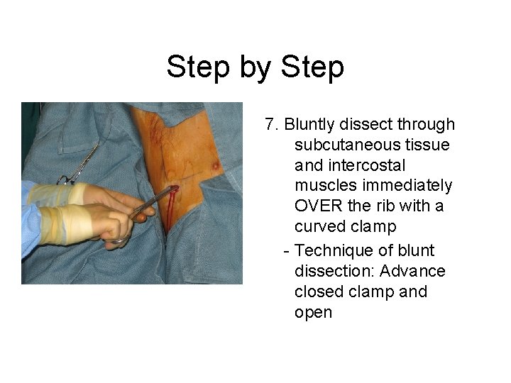 Step by Step 7. Bluntly dissect through subcutaneous tissue and intercostal muscles immediately OVER